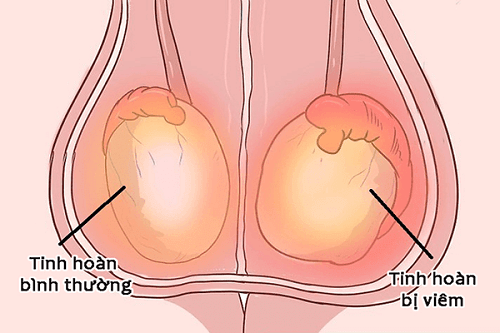 Viêm quy đầu ở nam giới không chữa trị sẽ gây ra viêm tinh hoàn